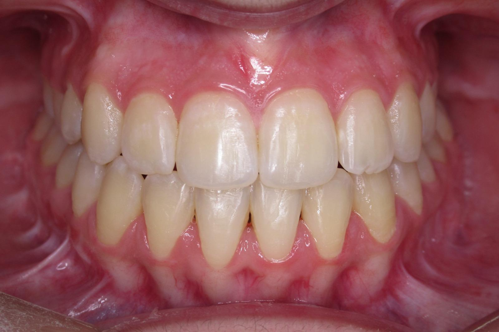 Orthodontics after