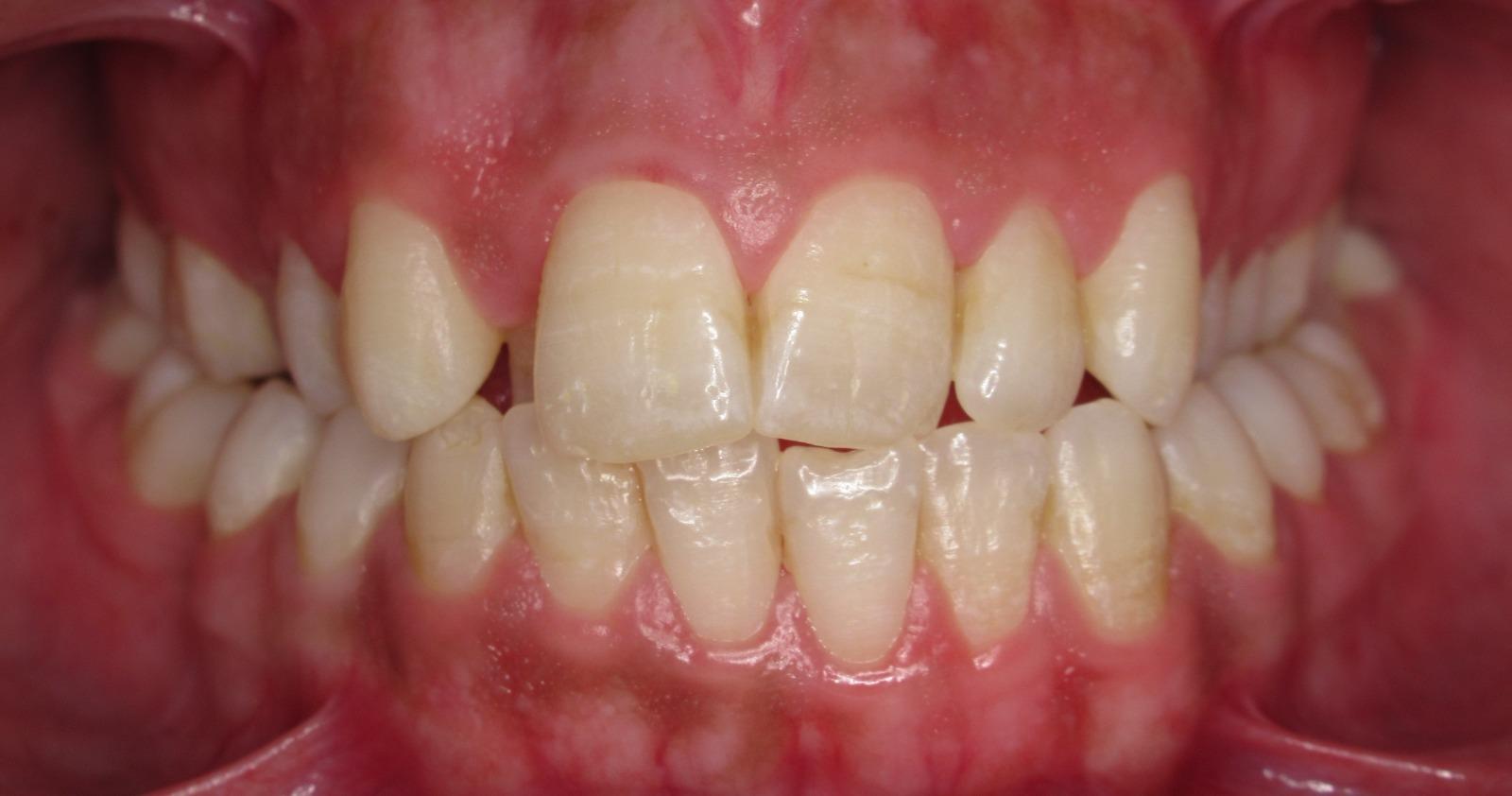 Orthodontics before