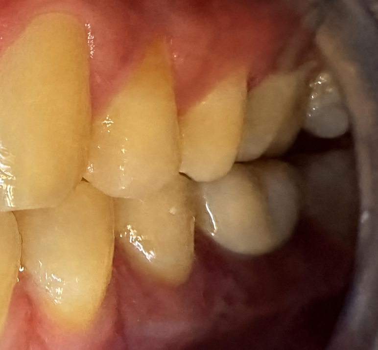 Crown after
