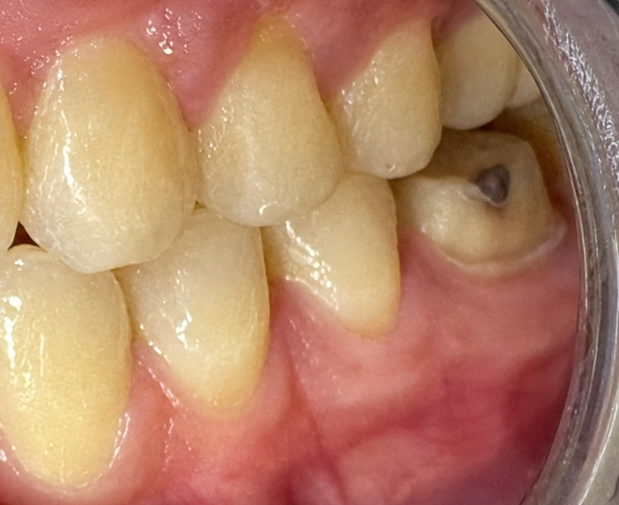 Crown before