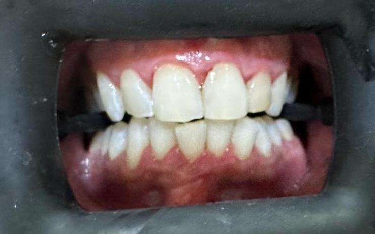 Whitening after
